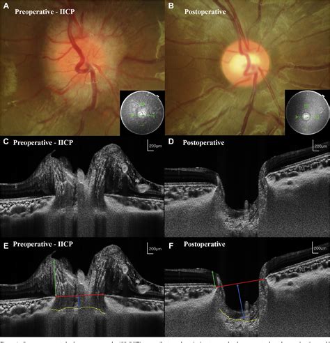 Figure 1 from Change in Optic Nerve After Intracranial Pressure ...