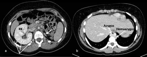 Case 2-Angio-CT (axial): a. left kidney (LK) hypoplasia with... | Download Scientific Diagram