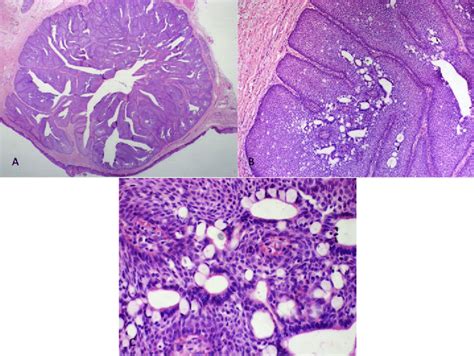 Histopathological features of the oral inverted ductal papilloma. A, B ...