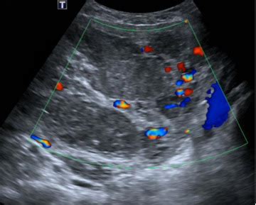 Imaging diagnosis of intravenous leiomyomatosis: an institutional ...