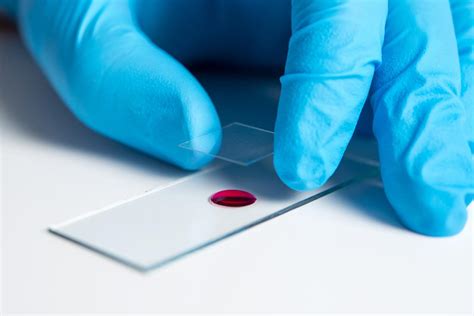 Alanine aminotransferase (ALT) test: Uses and results