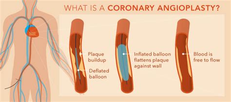 Coronary Angioplasty and Heart Stenting in Kolkata – Heart Health Guide – Medium