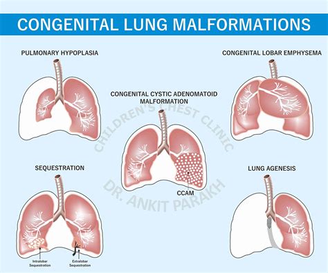 Congenital Lung Diseases - Dr. Ankit Parakh