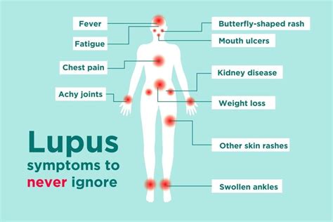 What Are The Best Treatments Available For Lupus? - wLoger - Advancing Your Health