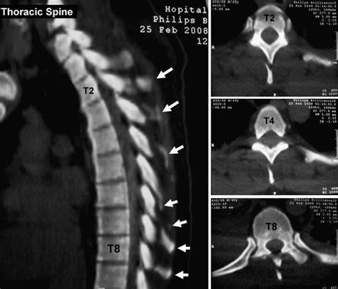 Multiple isolated thoracic spinous process fractures (Clay-Shoveler’s fracture) - The Spine Journal