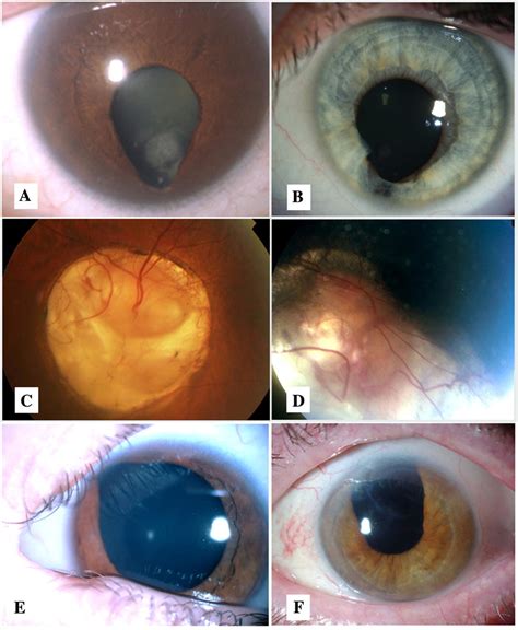 Coloboma Of The Eye