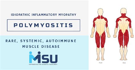 How To Prevent Polymyositis - Treatbeyond2