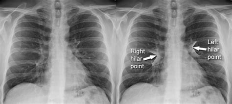 Hilum Chest X Ray