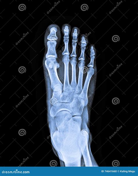 X Ray of right foot stock photo. Image of care, anatomy - 74641660