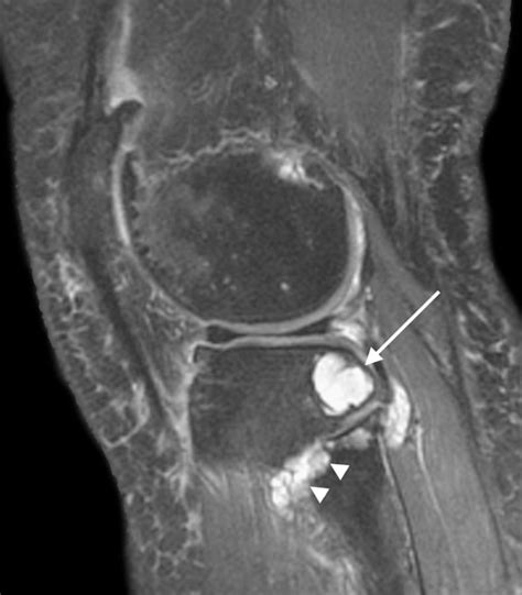 Pcl Ganglion Cyst Mri