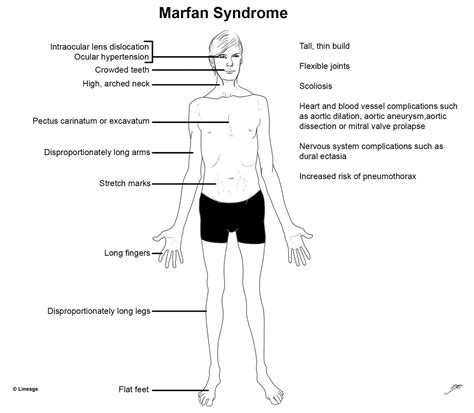 Marfan syndrome: genetics, symptoms, diagnosis and treatment - Online ...