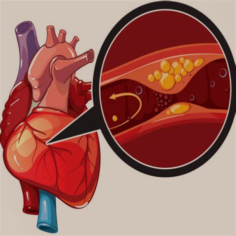 What causes heart disease? - Heart and Vascular Centre