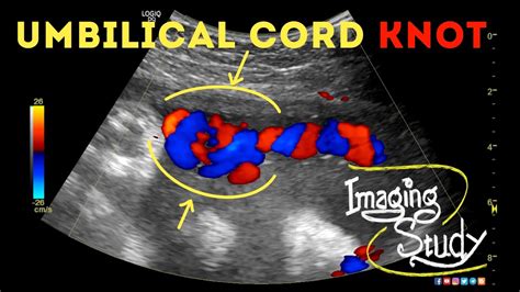 Umbilical Cord Knot || Ultrasound || Doppler || Case 40 - YouTube