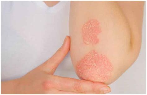 Ringworm vs Psoriasis - Causes, Symptoms, Treatment, Differences - Your Health Remedy