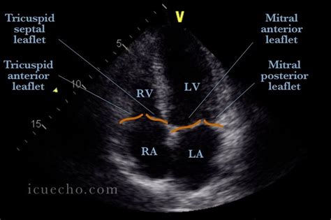 Apical 4 Chamber - ICU & Echo | Cardiac sonography, Tricuspid valve, Echo