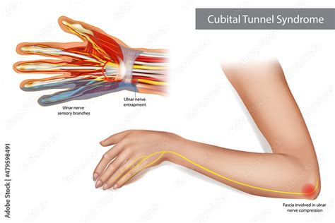 ulnar nerve entrapment - mi-pro.co.uk