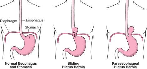 Hiatal Hernia: Symptoms, Causes, Treatment | IYTmed.com