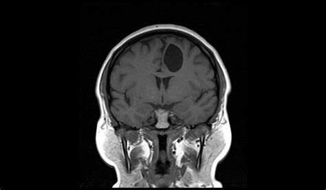 Neuroglial Cysts MRI | Radiology Article on Glioependymal Cysts