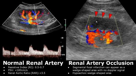 Renal Artery Doppler Ultrasound Normal Vs Abnormal Images | Stenosis/Occlusion/AVM | Kidney USG ...