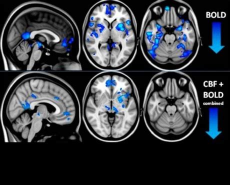 Magic mushrooms' effects illuminated in brain imaging studies ...