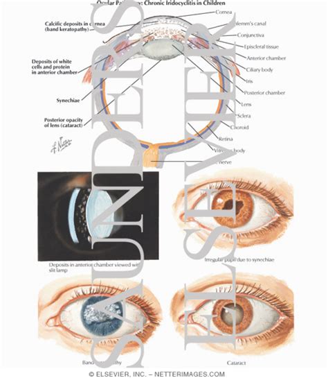 Chronic Iridocyclitis of