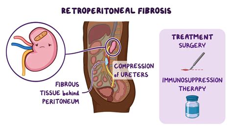 Retroperitoneal Space