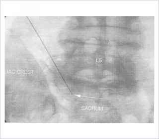 Technique of Inferior Hypogastric Block - Pelvic Floor