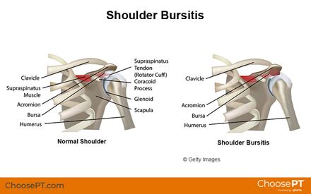 Shoulder Bursitis Injury Treatment Guide | The Best Porn Website