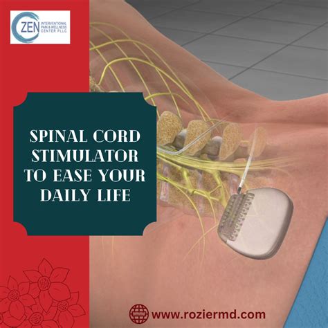 Spinal Cord Stimulator To Ease your Daily Life in Mansfield, Tx