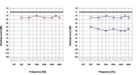 Audiology Clinical Masking | Treatment & Management | Point of Care