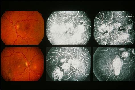 Central Serous Retinopathy - Retina Image Bank