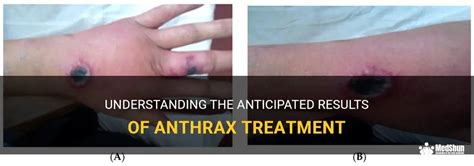 Understanding The Anticipated Results Of Anthrax Treatment | MedShun