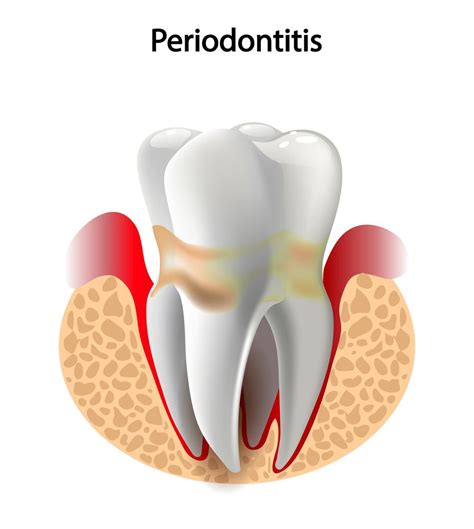 types of periodontal disease Medical pictures info – periodontal disease - Diseases Club center