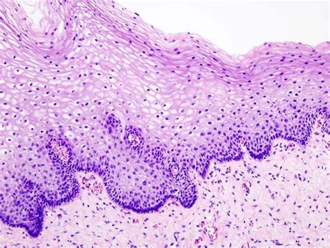 cellule epiteliali pavimentose | Cervical intraepithelial neoplasia ...