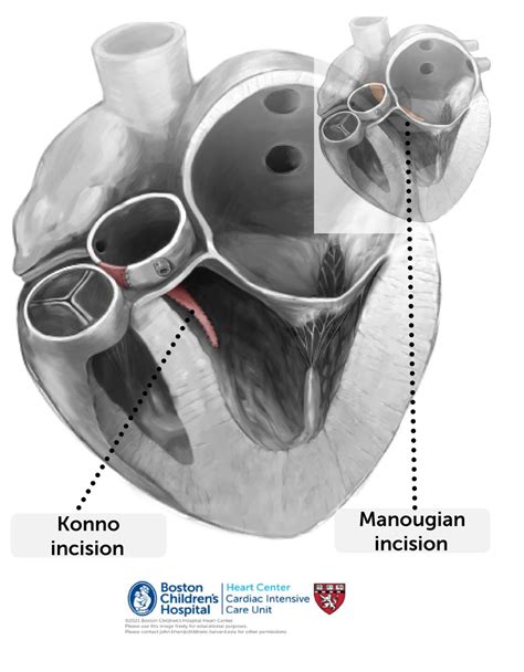 Aortic root enlargements – Online supplement