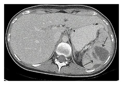 Splenic abscesses noted on CT scan (arrows). | Download Scientific Diagram