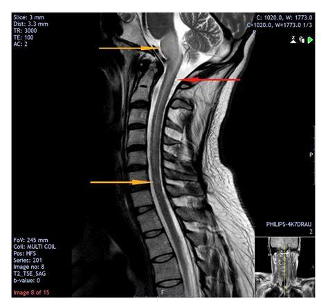 Cureus | Intracranial Dural Arteriovenous Fistula Presenting With ...