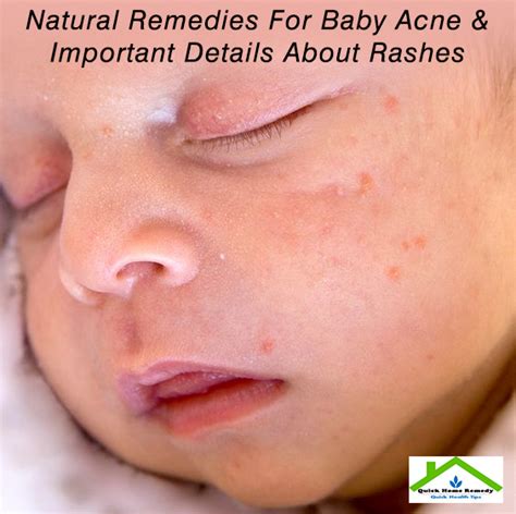 Baby-Acne-Home-Remedy | QuickHomeRemedy