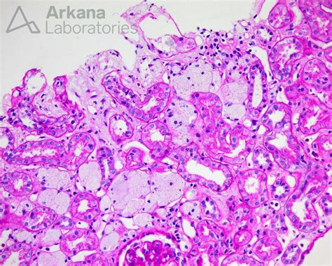 Alport Syndrome | Diagnose This! | Arkana Laboratories