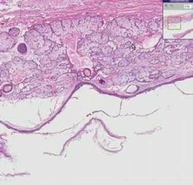 Histopathology Ovary--Dermoid cyst - YouTube