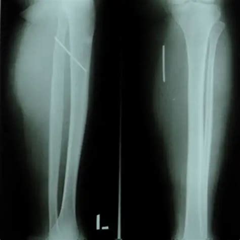 X-ray Both Leg AP & LAT | Test Price in Delhi | Ganesh Diagnostic