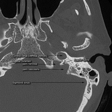 3D reconstruction of COCHLEA | Radiology, Diagnostic imaging, Medical anatomy