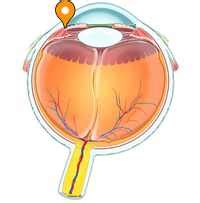 Iridocorneal angle - e-Anatomy - IMAIOS