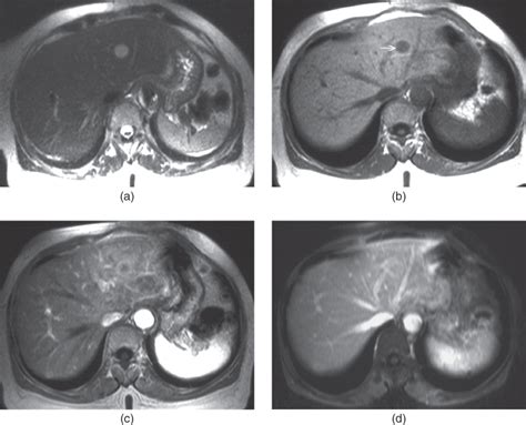 Liver metastases | Radiology Key