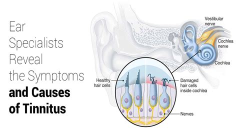 Ear Specialists Reveal the Symptoms and Causes of Tinnitus