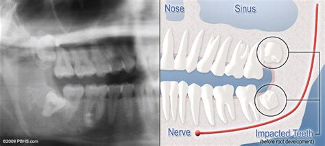 Normal Wisdom Teeth Growth