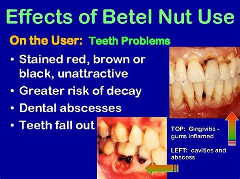 Drugs of the South Pacific Betel Nut