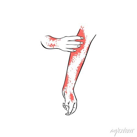 Hand drawn sketch of hands with scabies, vector illustration posters ...