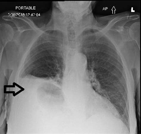 Cureus | Adult Onset Morgagni Hernia: Medical vs. Surgical Management