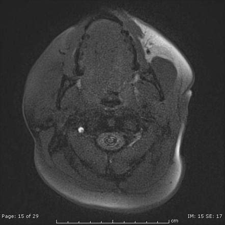 Vertebral artery dissection | Radiology Reference Article | Radiopaedia.org